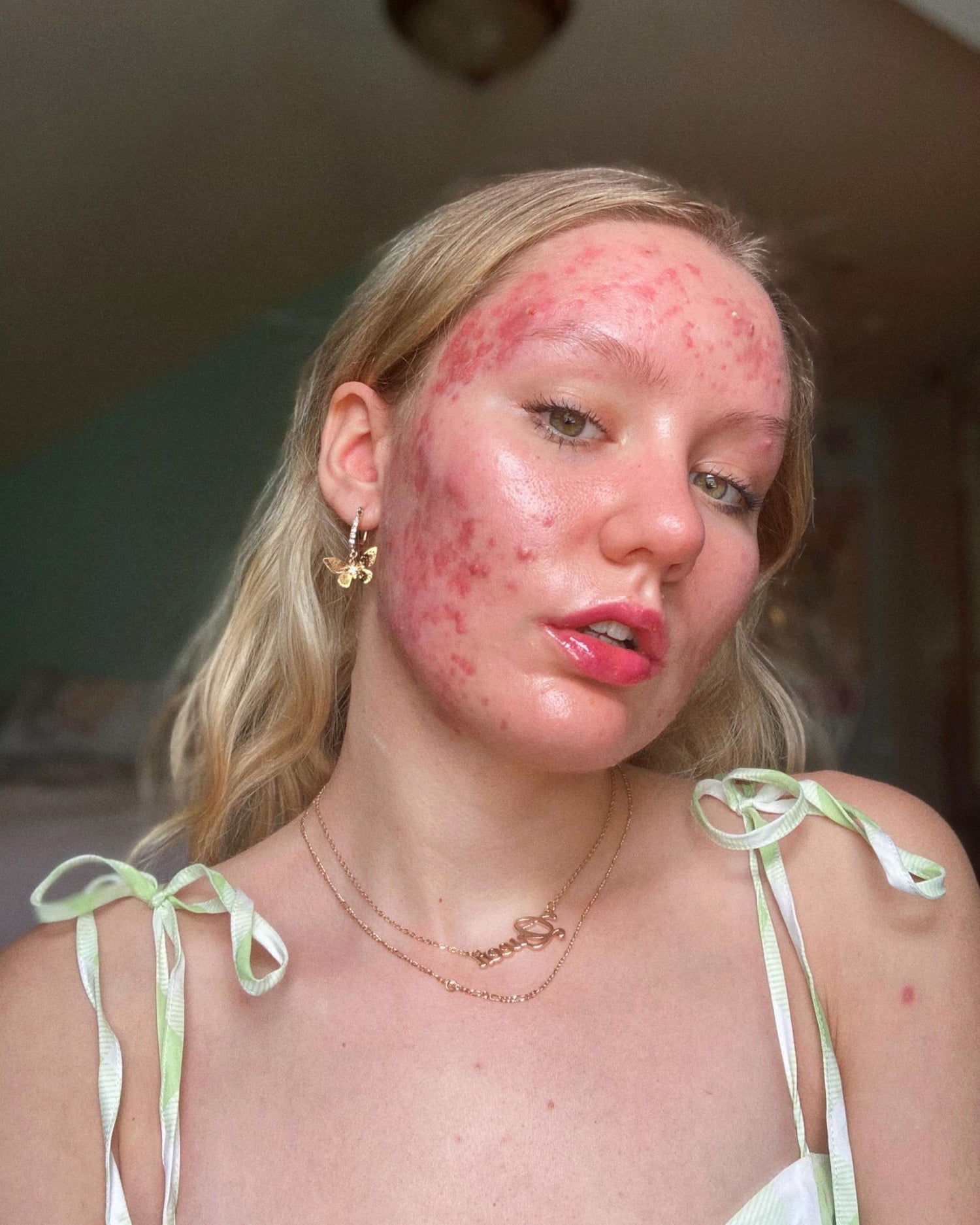 My Accutane Experience & Post-Accutane Skincare Routine | Acne Skin Stories