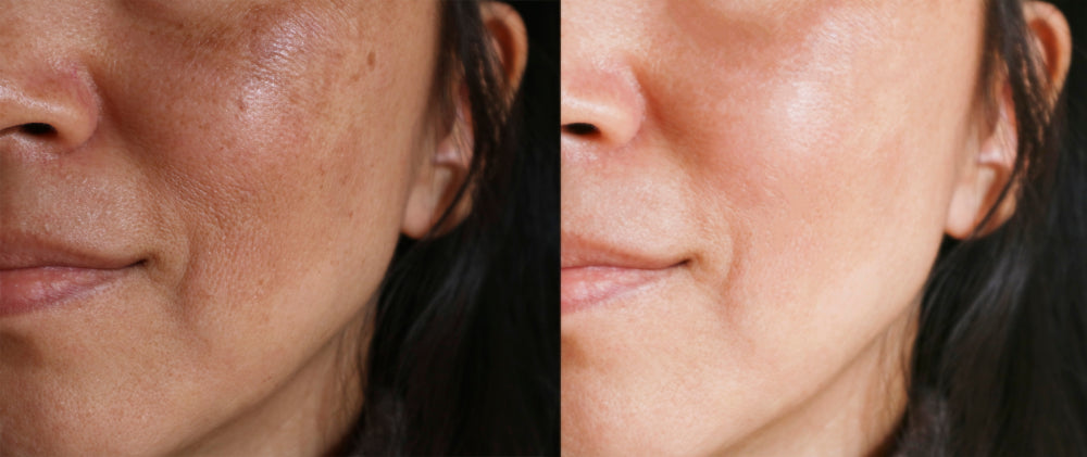 How to Treat Melasma During Pregnancy | The ‘Pregnancy Mask’