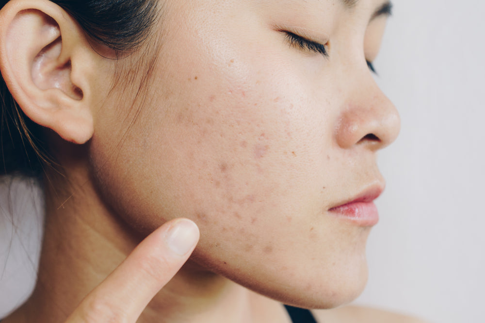 How long does it take to fade acne scars?