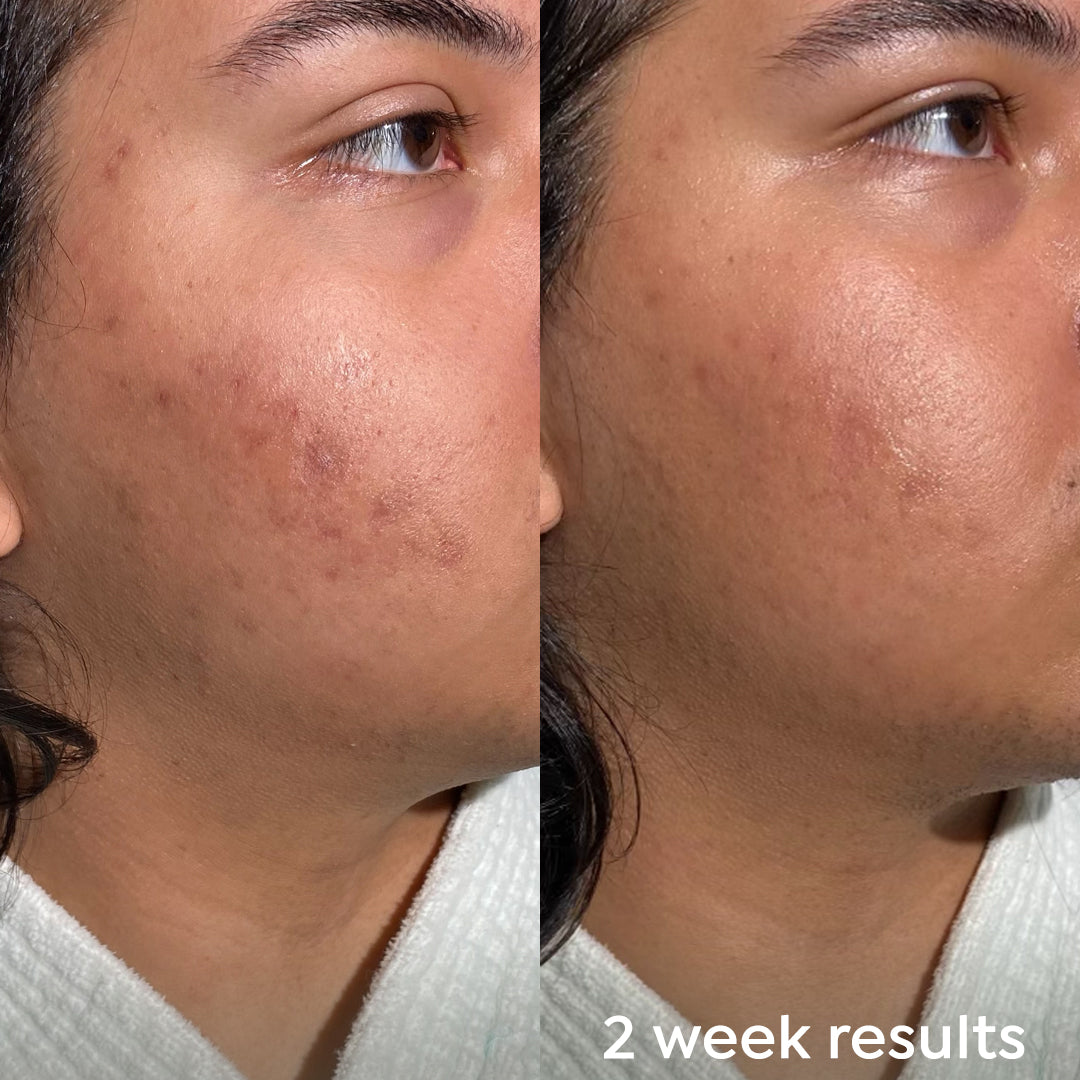 Before and after using Dr. Zenovia Scar Gel Treatment – visible reduction in acne scars