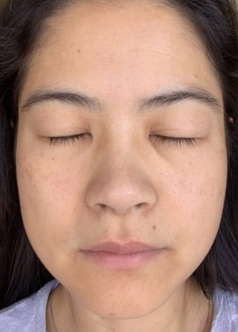 Before use of Dr. Zenovia Advanced Retinol Night Repair Treatment | Clear Complexion | Hormonal Dermatology