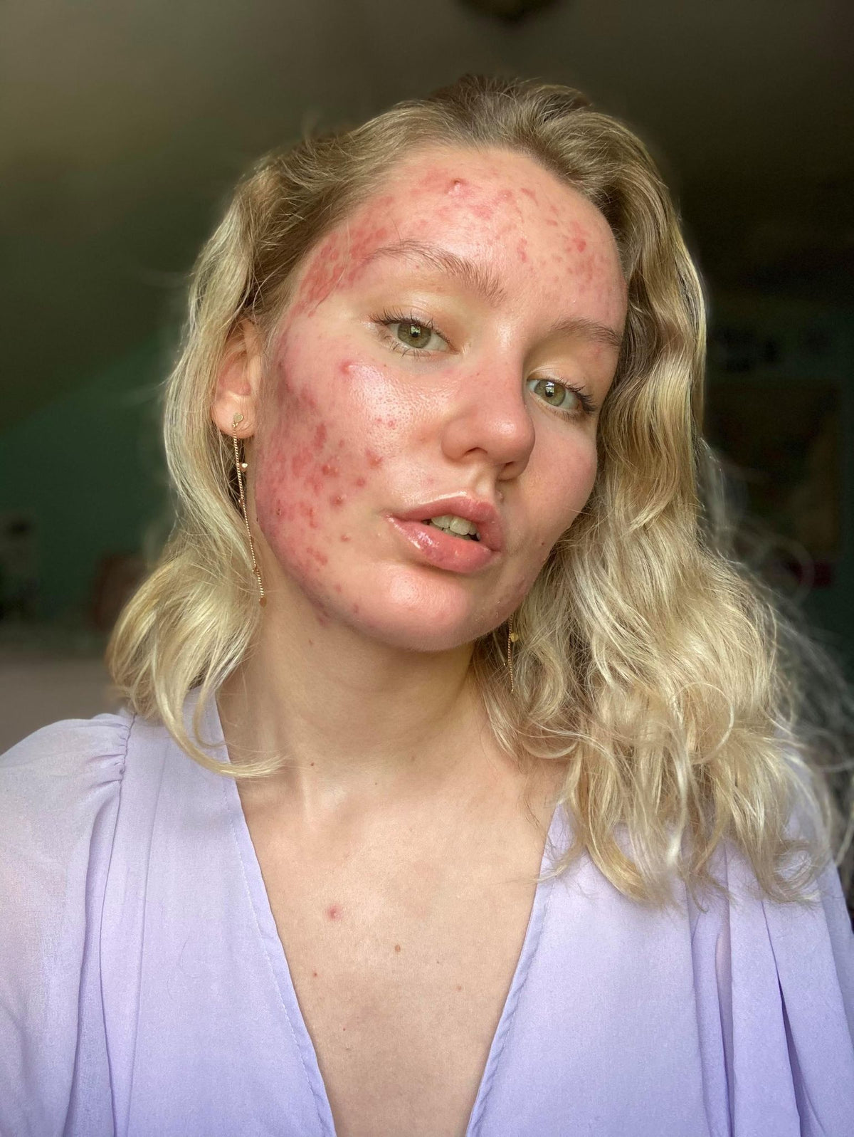 Cystic acne treatment discount