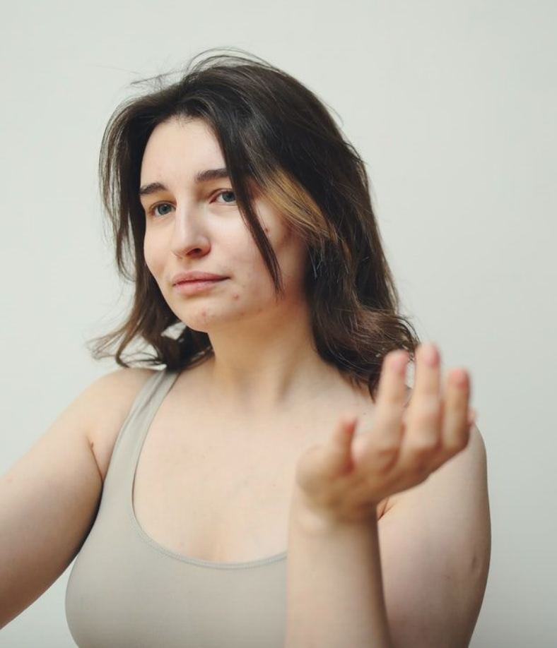 What Causes Hormonal Acne in Women?