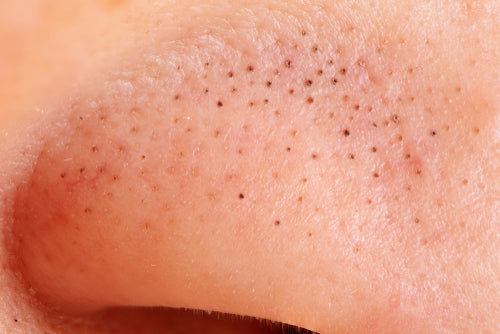 How to Get Rid of Blackheads | Derm-Approved Skin Treatments.