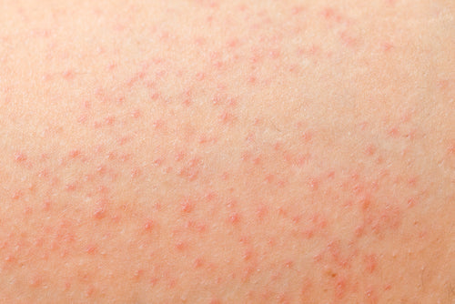 Is It Body Acne or Folliculitis? | Skin Stories.
