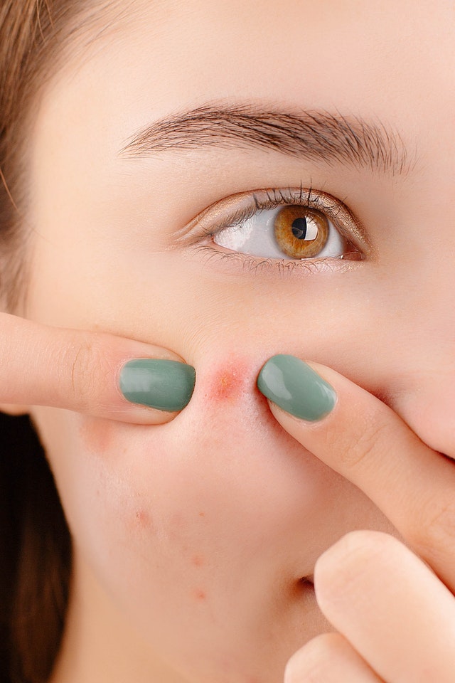 How to Safely Pop Your Pimples | Acne Sessions with Dr. Zenovia.