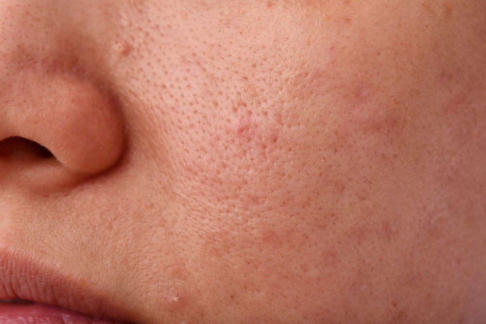 Clogged pores hotsell