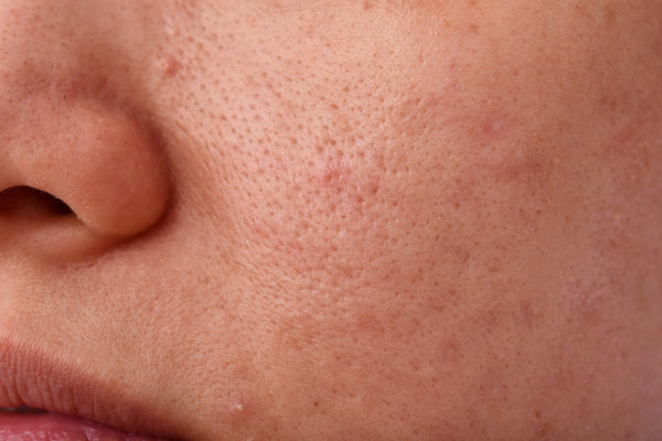 5 Best Ways to Fight Clogged Pores