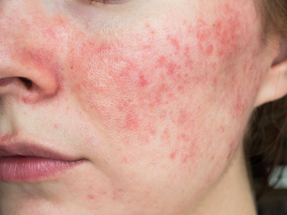 Derm-Approved Rosacea Skin Care Routine | Rosacea Awareness Month.