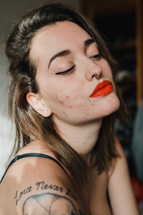 How to Clear Hormonal Acne From the Inside Out | 10 Derm-Approved Tips