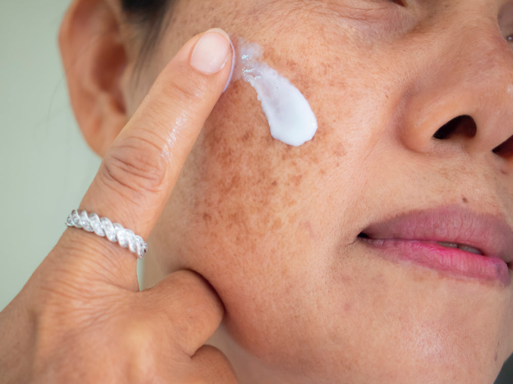 Melasma: Causes, Prevention, & Treatments