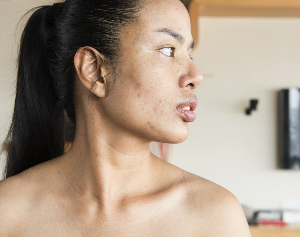 Hormonal Jawline Acne: Where Does It Come From?.