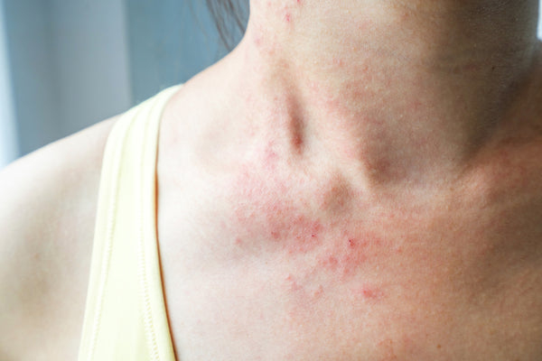 Eczema: Symptoms, Treatments, and Prevention