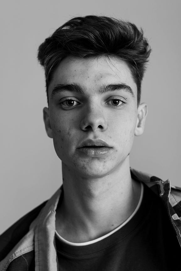 Hormonal Acne in Men is Different- And Sometimes Worse.