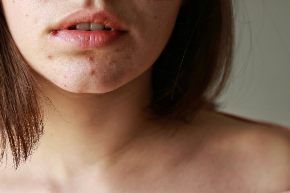How to Get Rid of Hormonal Chin Acne.