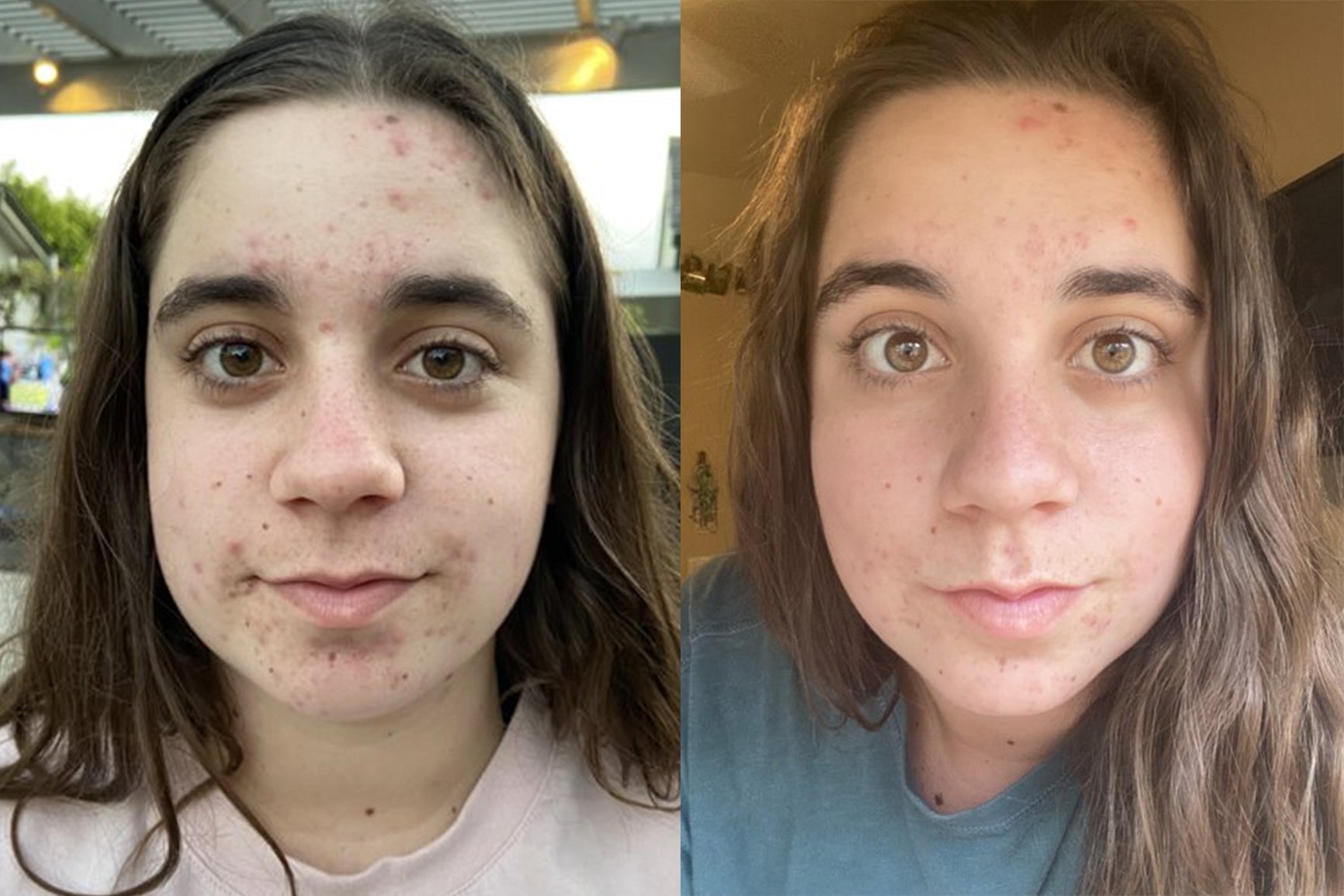 How to clear teen acne 
