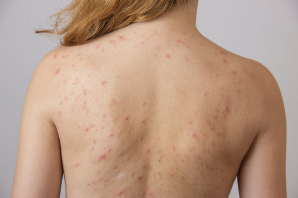 How to Get Rid of Hormonal Body Acne on the Back, Chest
