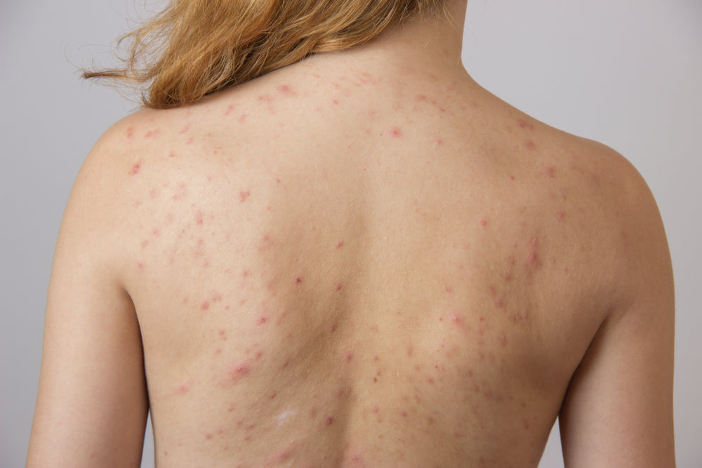 How to Get Rid of Hormonal Body Acne on the Back, Chest & Shoulders.