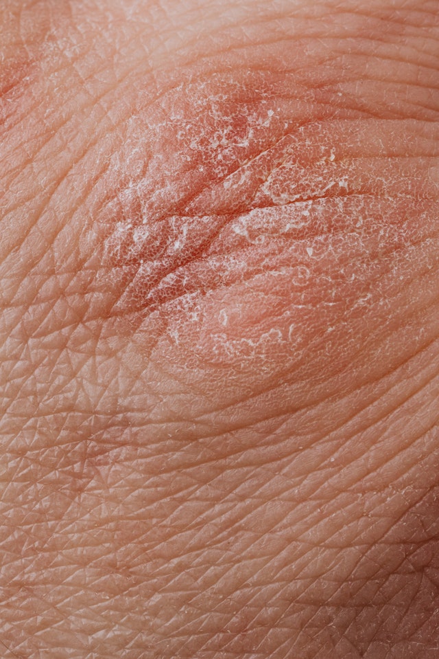 Dry skin and hormonal imbalance in women