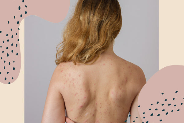 The 7 surprising reasons we get bacne back acne