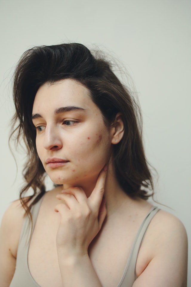 Is Your Acne Hormonal? | Question for the Derm.