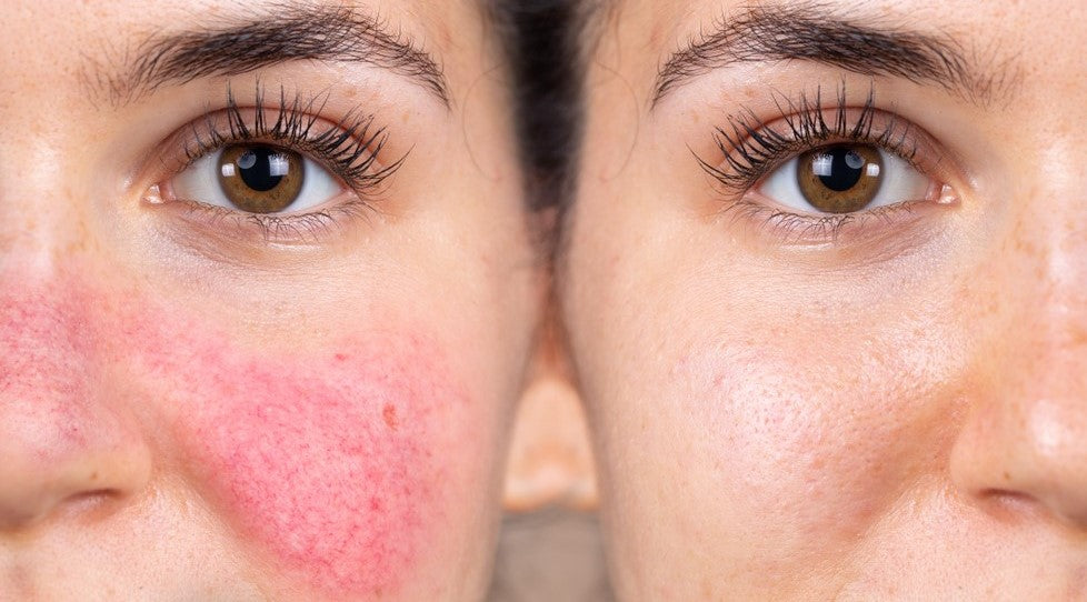 Rosacea: Symptoms, Causes, and Top Treatments.