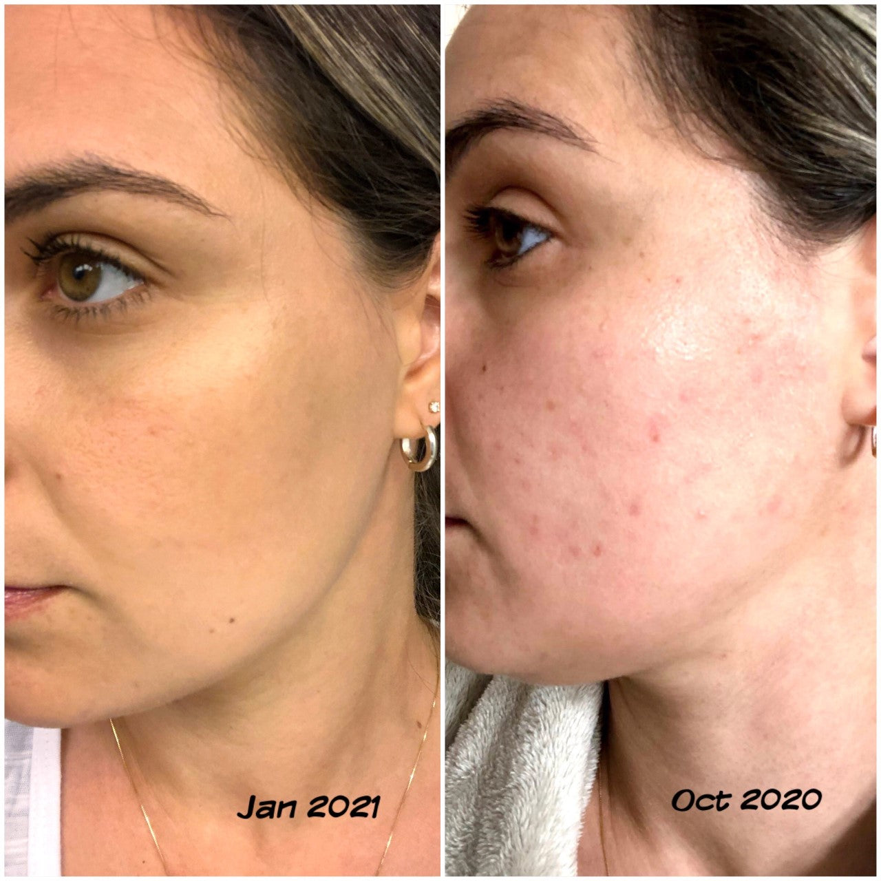 How I Cleared My Postpartum Hormonal Acne | Skin Stories