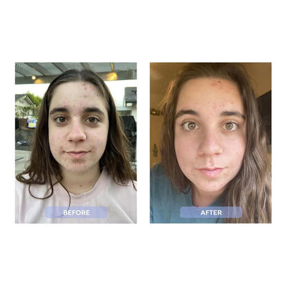 Before and after comparison of a person with acne on their face after using the acne system.