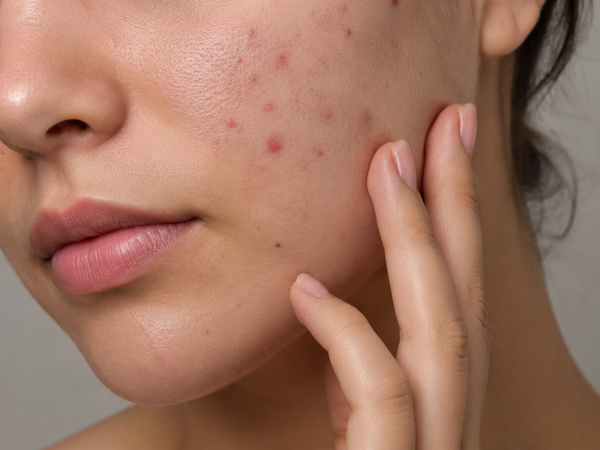 Close-up of a person's face showing acne blemishes on the cheek, with fingers touching the skin against a neutral gray background.