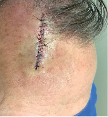 Close-up of a person's scalp with a vertical surgical incision and stitches, labeled 'BASELINE' in the top-left corner.
