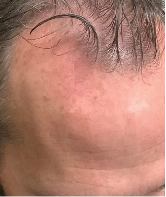 Close-up of a man's scalp showing hair growth progress after 6 weeks, with a black diagonal banner in the top-left corner reading 'AFTER 6 WEEKS'.