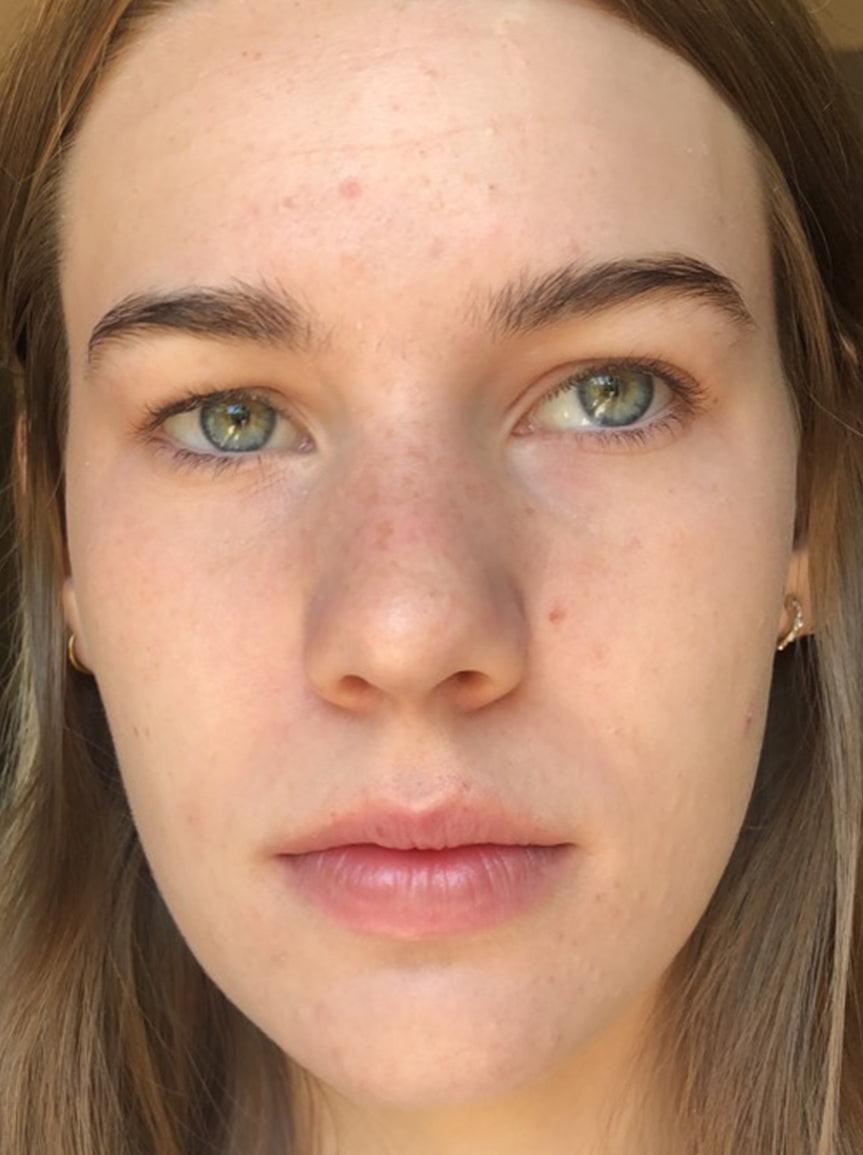 Skin after using Dr. Zenovia 10% Benzoyl Peroxide Acne Cleanser, showing a clearer complexion