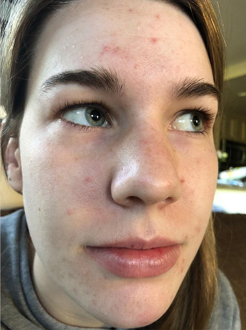 Acne-prone skin before using Dr. Zenovia 10% Benzoyl Peroxide Acne Cleanser