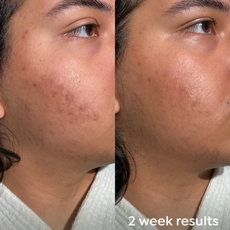 Before and After - Dr Zenovia Scar Gel Treatment