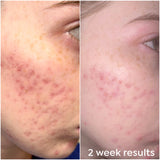 Before and after using Dr. Zenovia Scar Gel Treatment – visible reduction in acne scars
