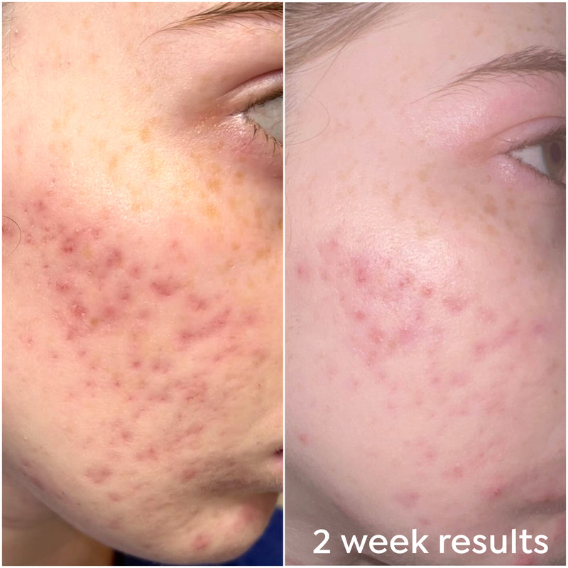 Before and after using Dr. Zenovia Scar Gel Treatment – visible reduction in acne scars