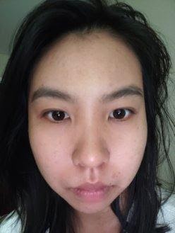 Close-up of skin after using the Aloe Vera Moisturizer, showing a clearer, hydrated complexion