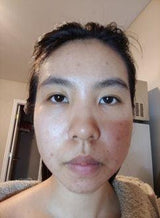 Close-up of acne-prone skin before using the Aloe Vera Moisturizer