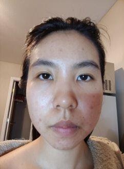Close-up of acne-prone skin before using the Aloe Vera Moisturizer